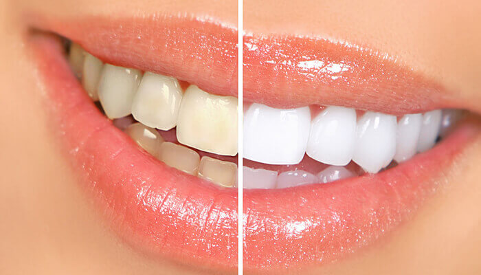 Estética dental
